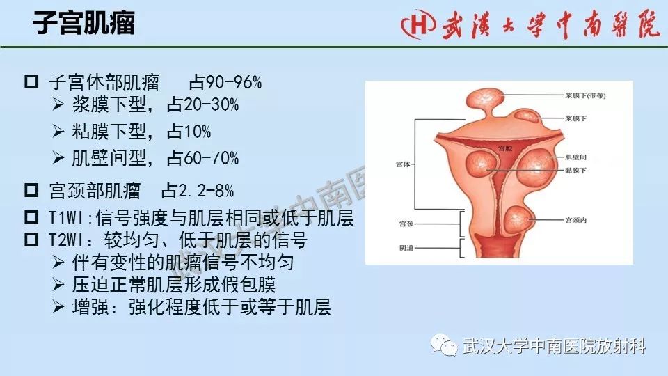 【PPT】女性生殖系统影像解剖及子宫常见疾病