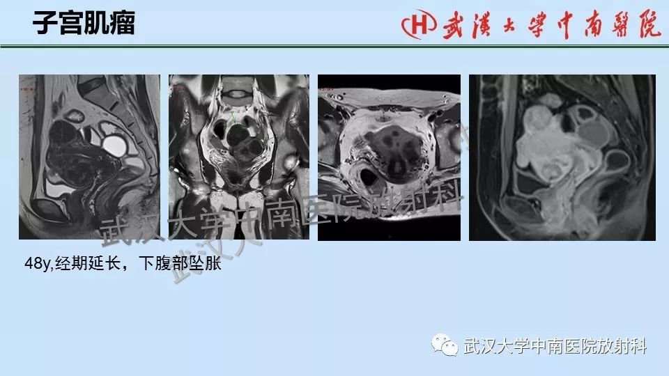 【PPT】女性生殖系统影像解剖及子宫常见疾病