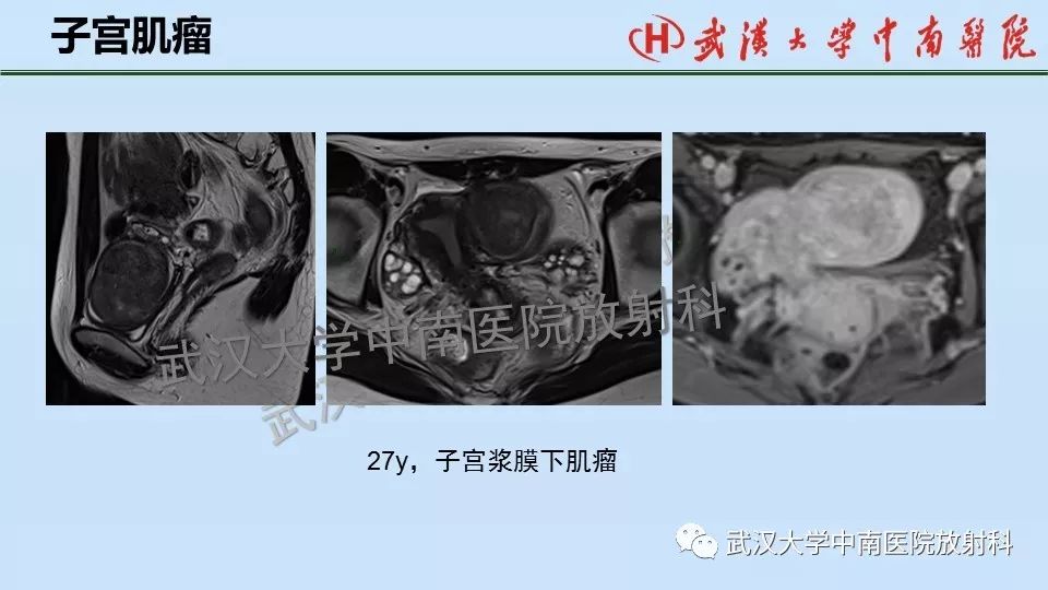 【PPT】女性生殖系统影像解剖及子宫常见疾病