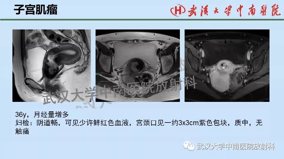【PPT】女性生殖系统影像解剖及子宫常见疾病