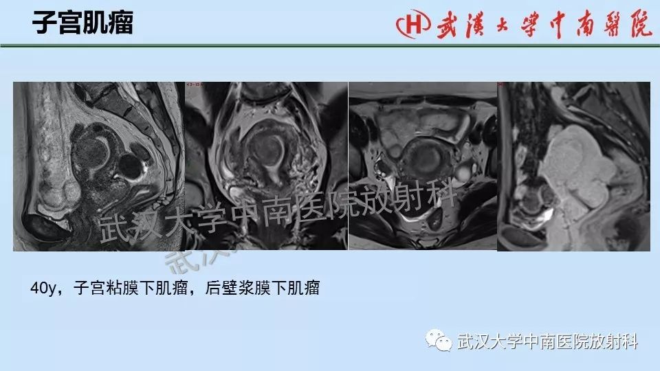 【PPT】女性生殖系统影像解剖及子宫常见疾病