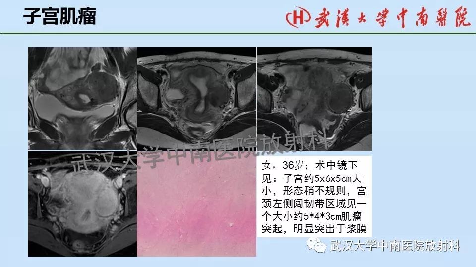 【PPT】女性生殖系统影像解剖及子宫常见疾病