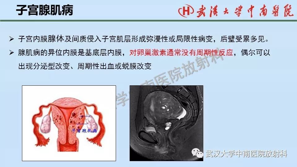 【PPT】女性生殖系统影像解剖及子宫常见疾病
