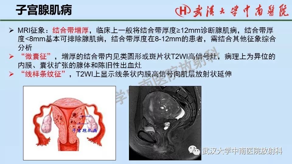 【PPT】女性生殖系统影像解剖及子宫常见疾病