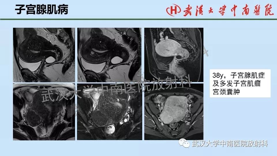 【PPT】女性生殖系统影像解剖及子宫常见疾病