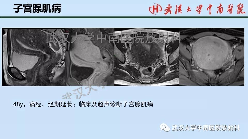 【PPT】女性生殖系统影像解剖及子宫常见疾病