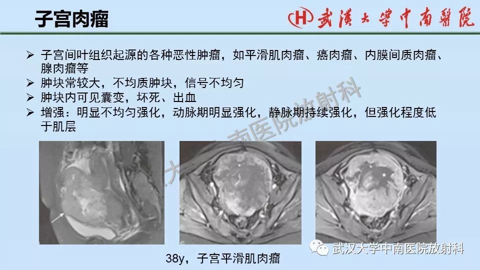 【PPT】女性生殖系统影像解剖及子宫常见疾病