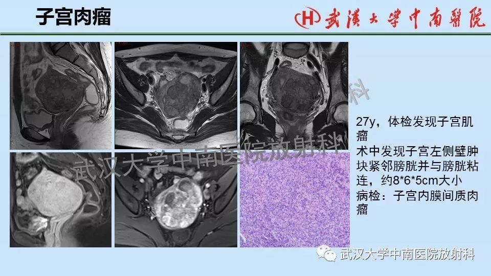 【PPT】女性生殖系统影像解剖及子宫常见疾病