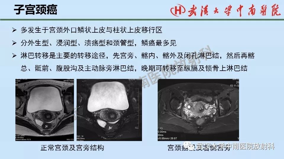 【PPT】女性生殖系统影像解剖及子宫常见疾病