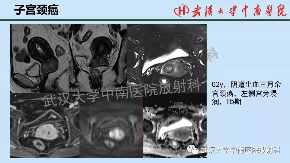 【PPT】女性生殖系统影像解剖及子宫常见疾病