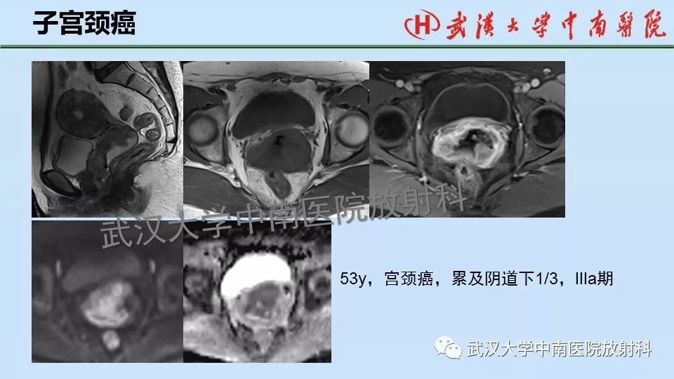 【PPT】女性生殖系统影像解剖及子宫常见疾病
