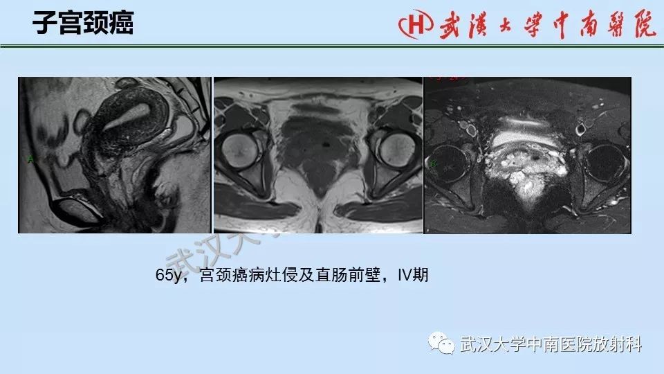 【PPT】女性生殖系统影像解剖及子宫常见疾病