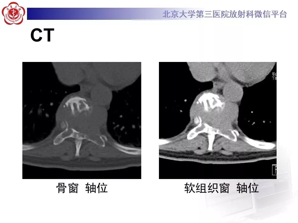 【病例】脊柱孤立性浆细胞瘤1例CT及MR影像
