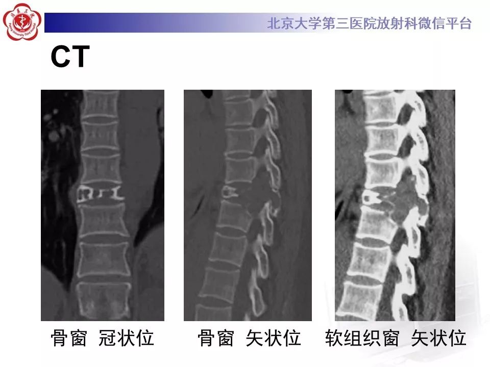 【病例】脊柱孤立性浆细胞瘤1例CT及MR影像