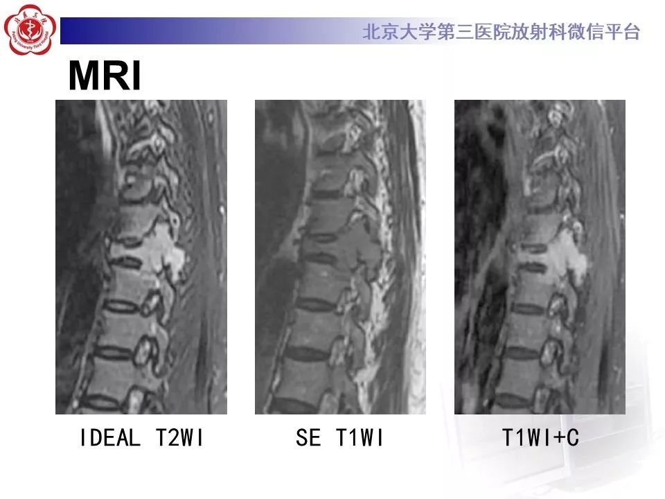 【病例】脊柱孤立性浆细胞瘤1例CT及MR影像