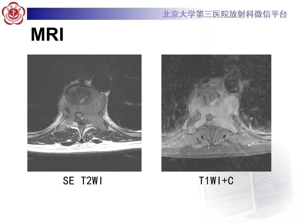 【病例】脊柱孤立性浆细胞瘤1例CT及MR影像