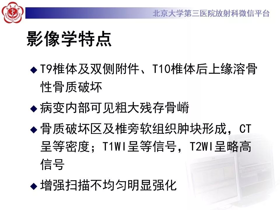 【病例】脊柱孤立性浆细胞瘤1例CT及MR影像