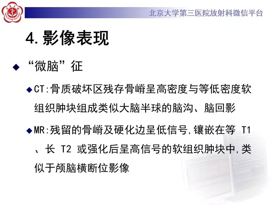 【病例】脊柱孤立性浆细胞瘤1例CT及MR影像