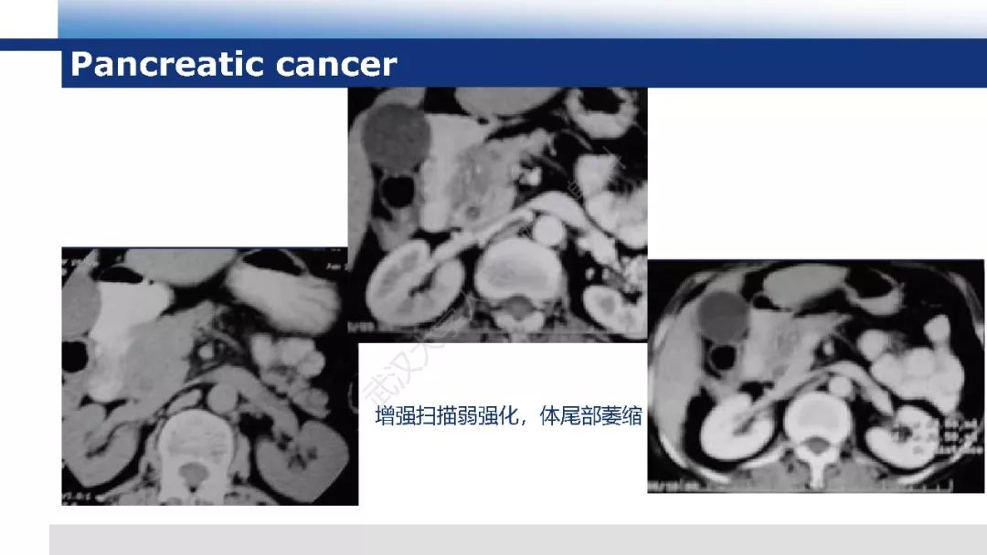 【PPT】胰腺淋巴瘤影像诊断