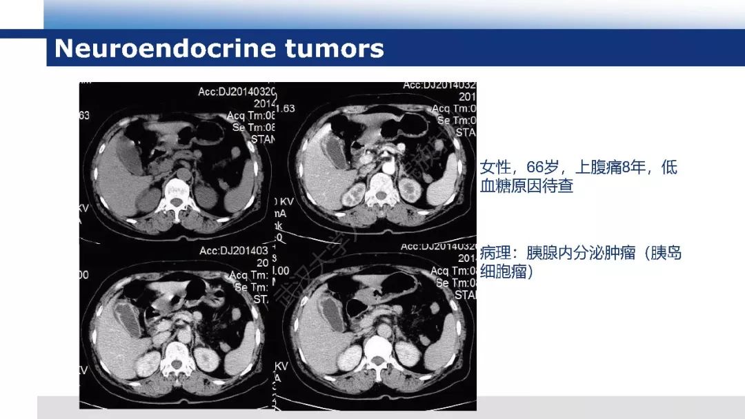 【PPT】胰腺淋巴瘤影像诊断
