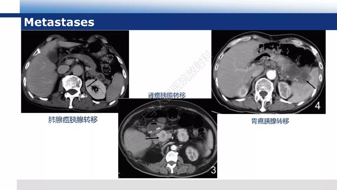 【PPT】胰腺淋巴瘤影像诊断