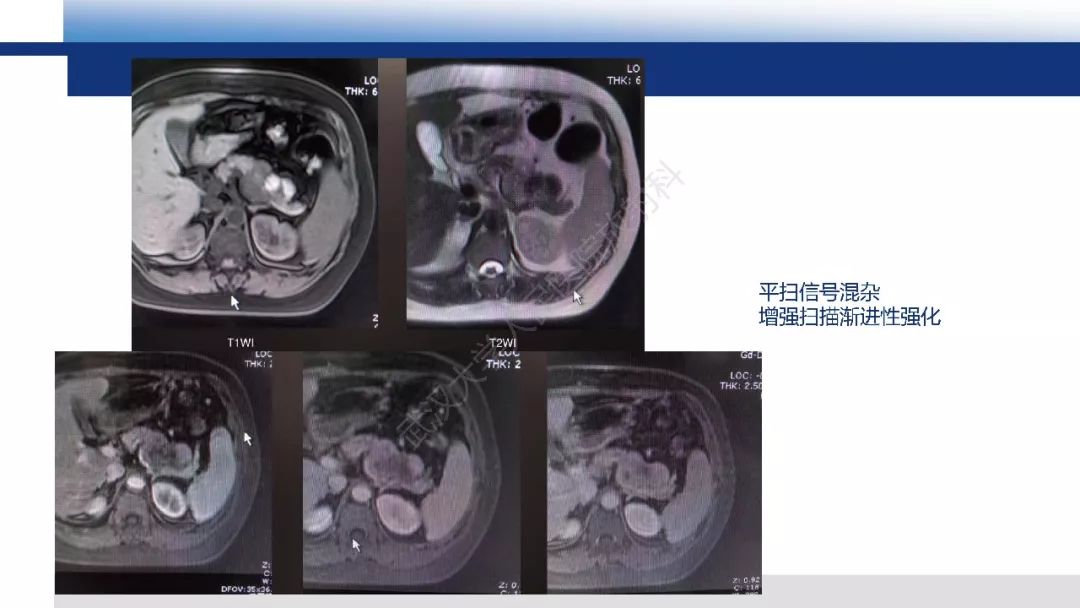 【PPT】胰腺淋巴瘤影像诊断