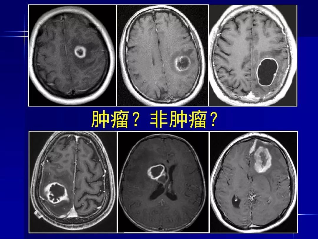 【PPT】脑内常见环形强化病变影像诊断与鉴别诊断