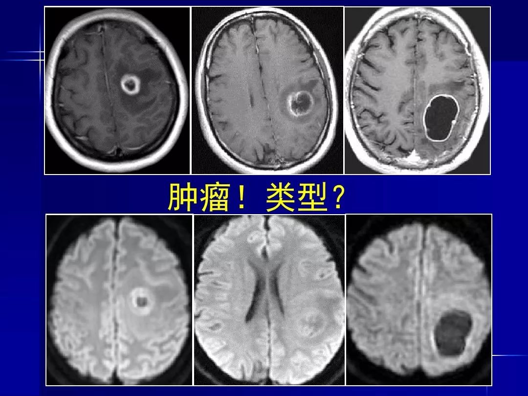 【PPT】脑内常见环形强化病变影像诊断与鉴别诊断