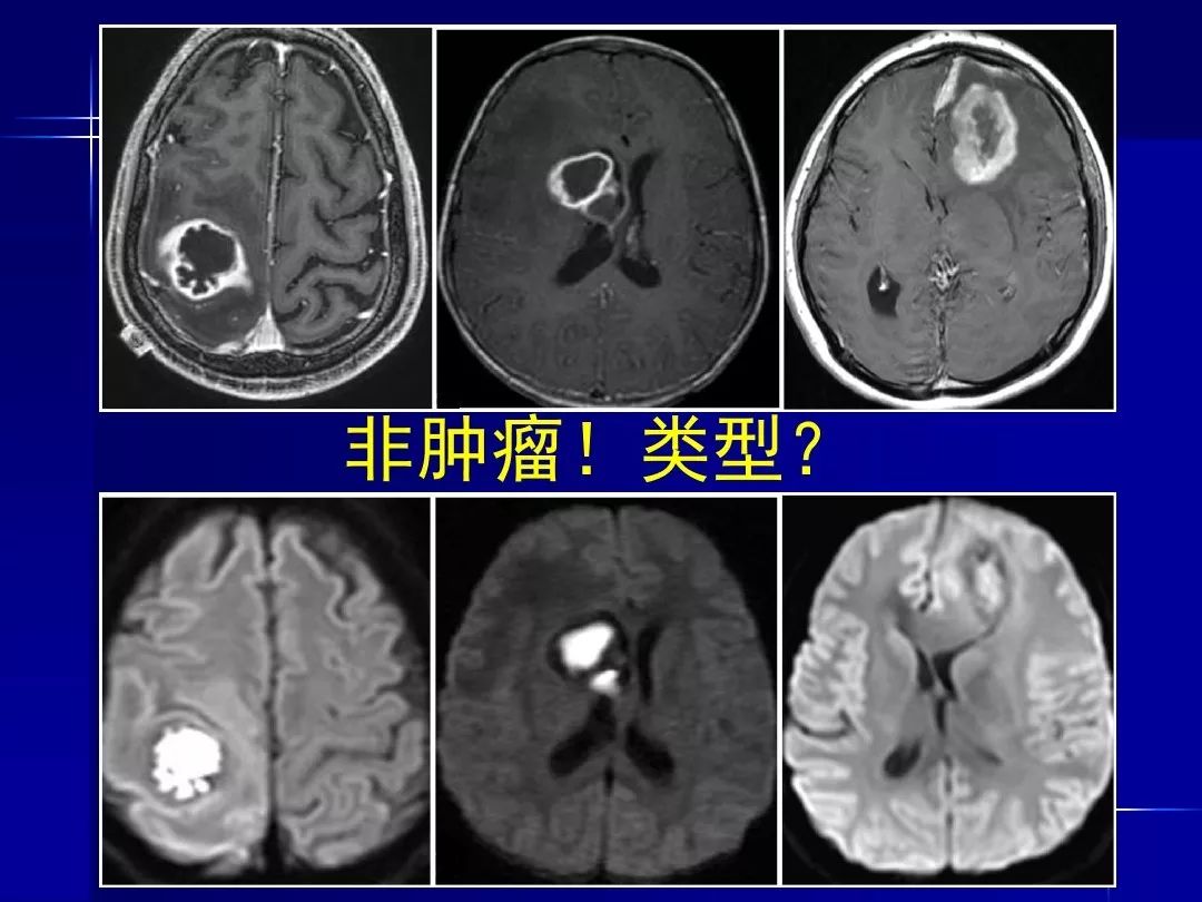 【PPT】脑内常见环形强化病变影像诊断与鉴别诊断