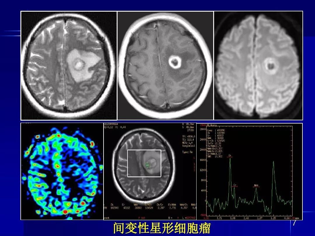 【PPT】脑内常见环形强化病变影像诊断与鉴别诊断