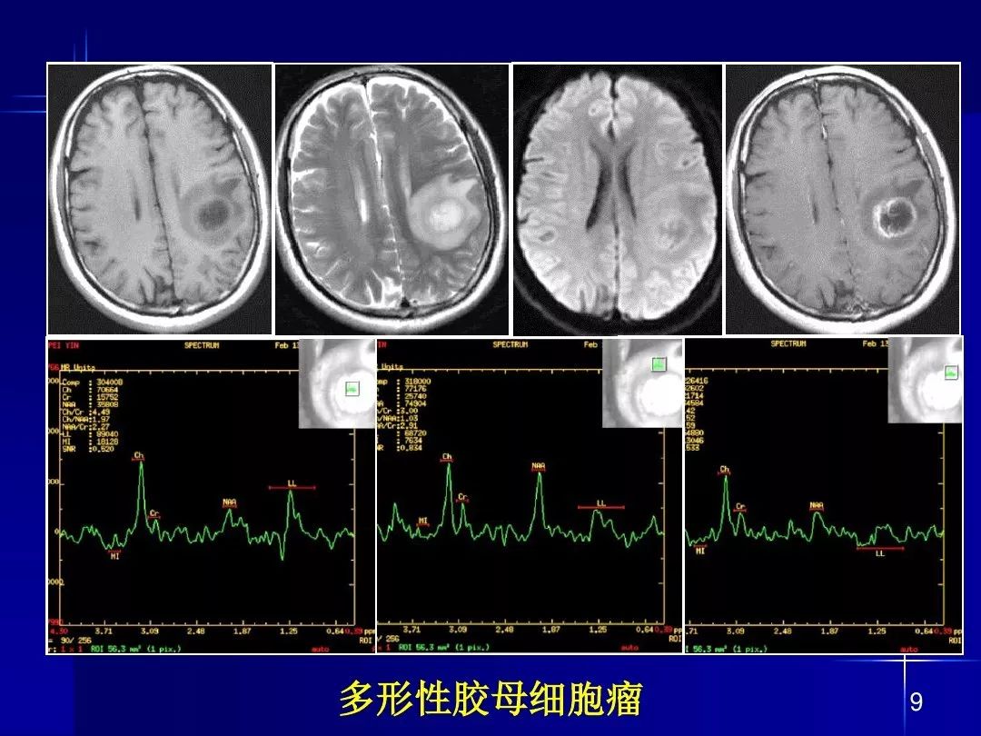 【PPT】脑内常见环形强化病变影像诊断与鉴别诊断
