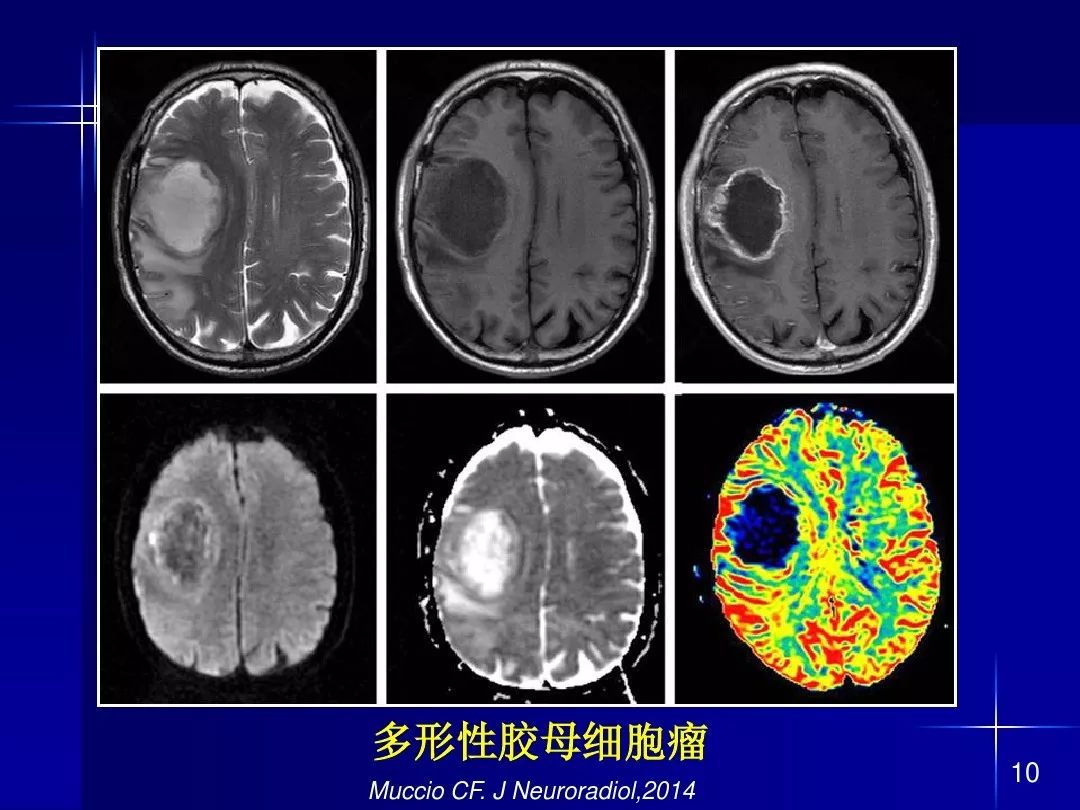 【PPT】脑内常见环形强化病变影像诊断与鉴别诊断