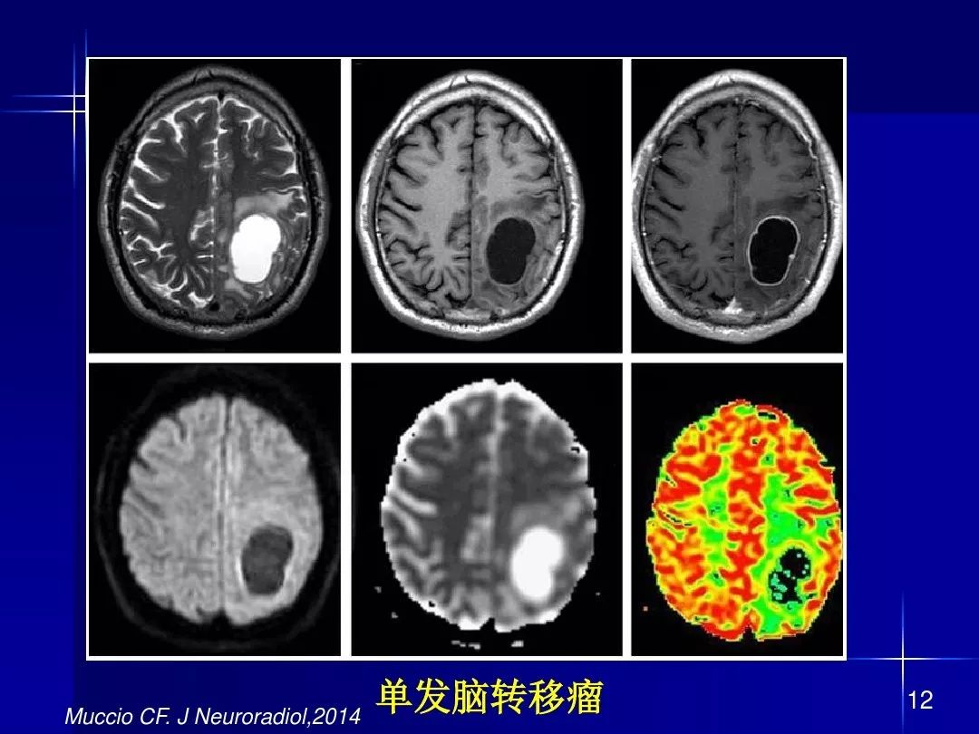 【PPT】脑内常见环形强化病变影像诊断与鉴别诊断