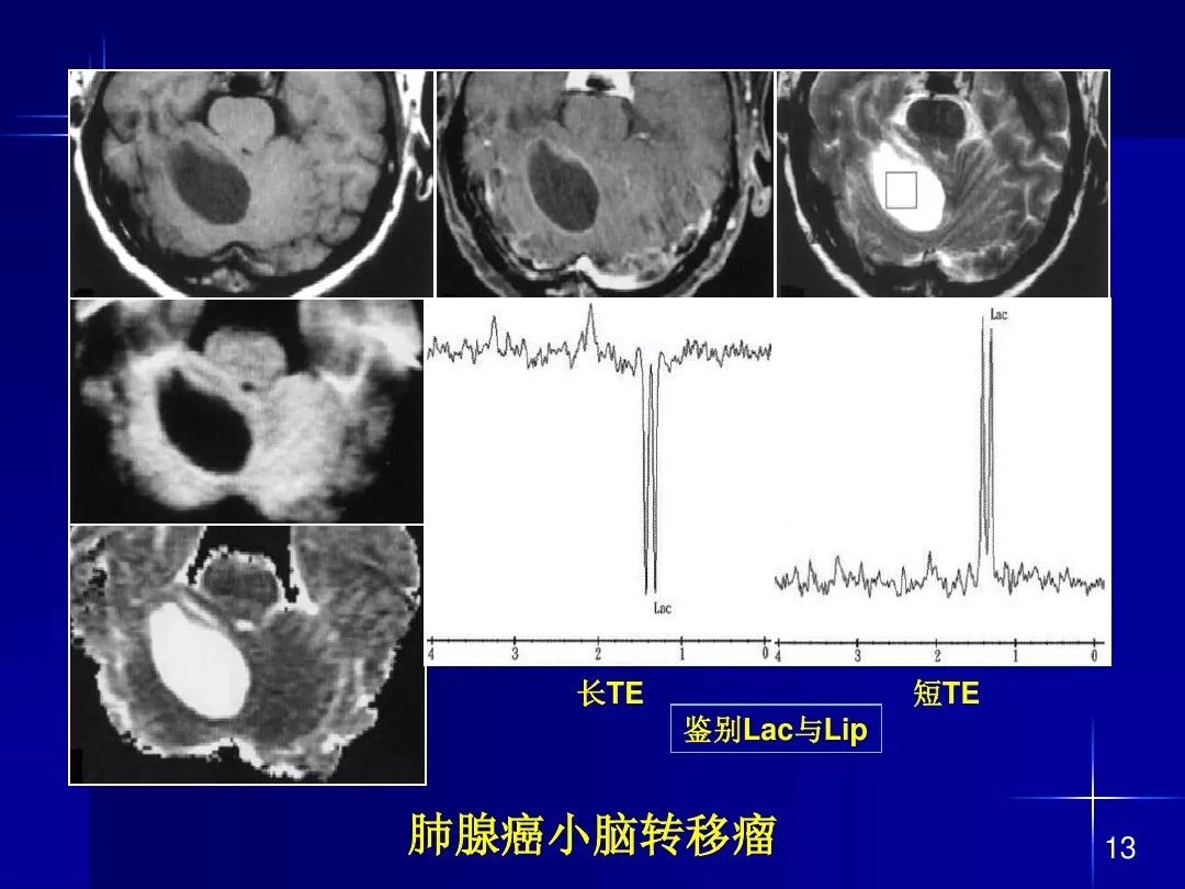 【PPT】脑内常见环形强化病变影像诊断与鉴别诊断