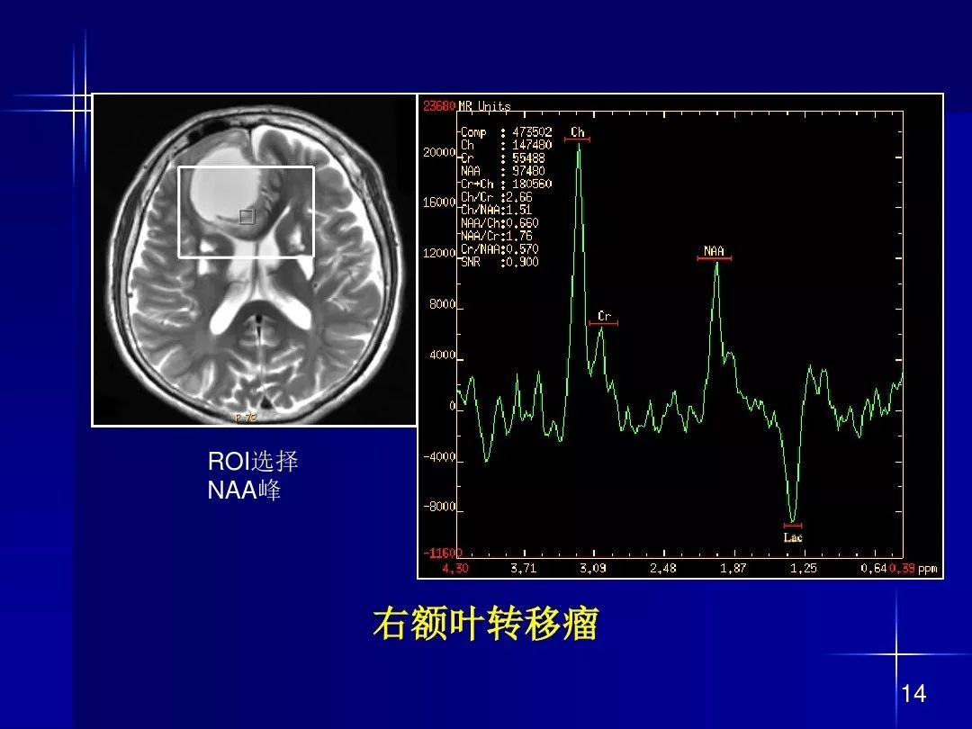 【PPT】脑内常见环形强化病变影像诊断与鉴别诊断