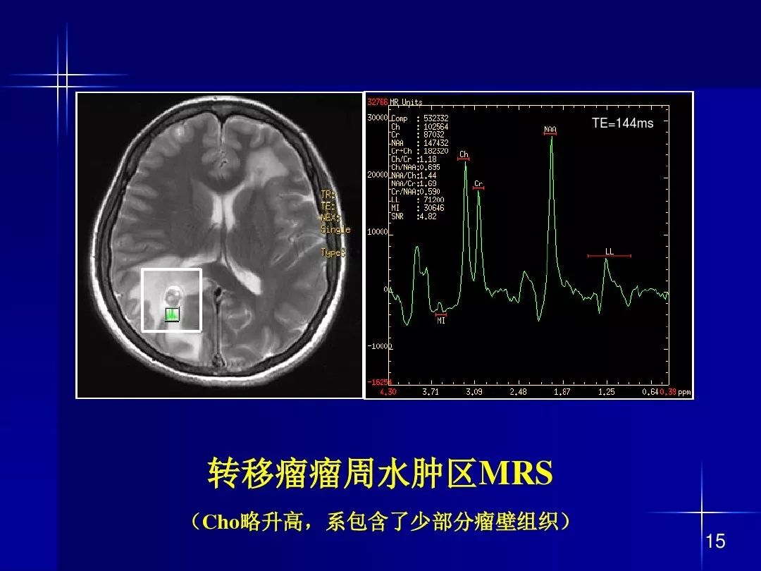【PPT】脑内常见环形强化病变影像诊断与鉴别诊断