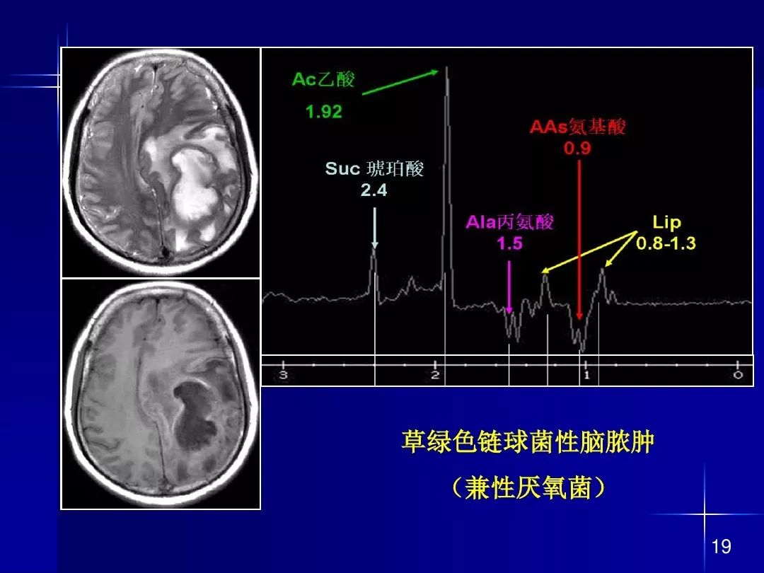 【PPT】脑内常见环形强化病变影像诊断与鉴别诊断