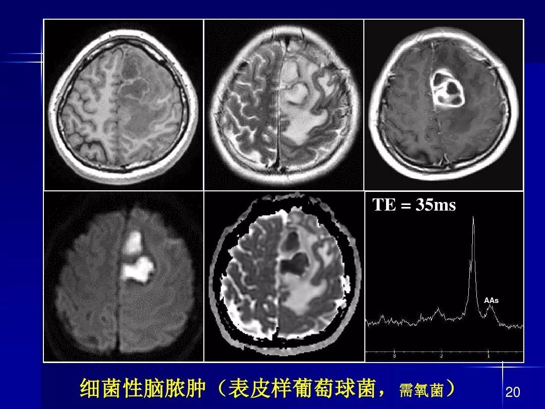 【PPT】脑内常见环形强化病变影像诊断与鉴别诊断