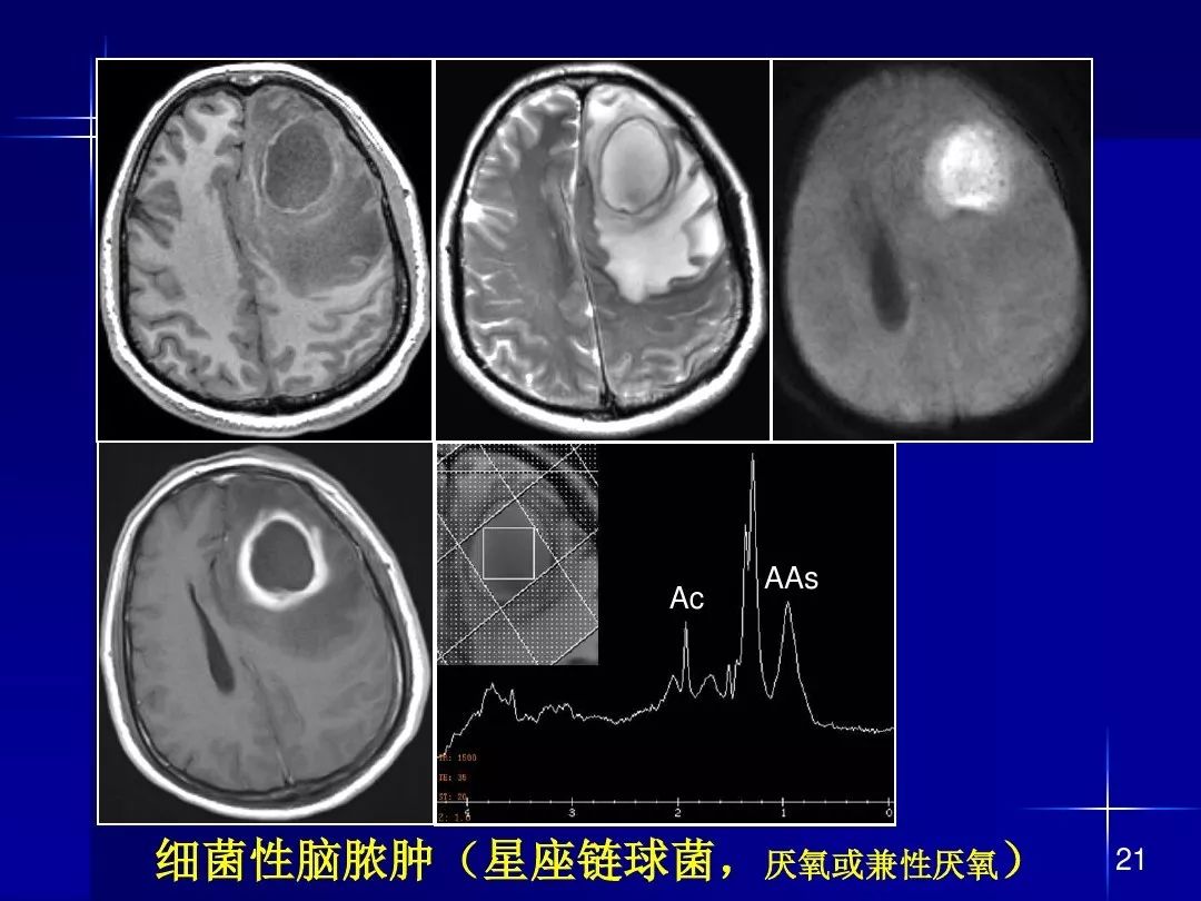 【PPT】脑内常见环形强化病变影像诊断与鉴别诊断