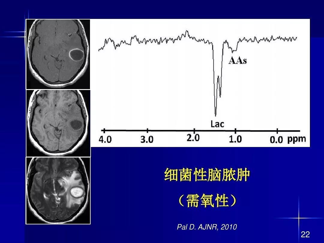 【PPT】脑内常见环形强化病变影像诊断与鉴别诊断