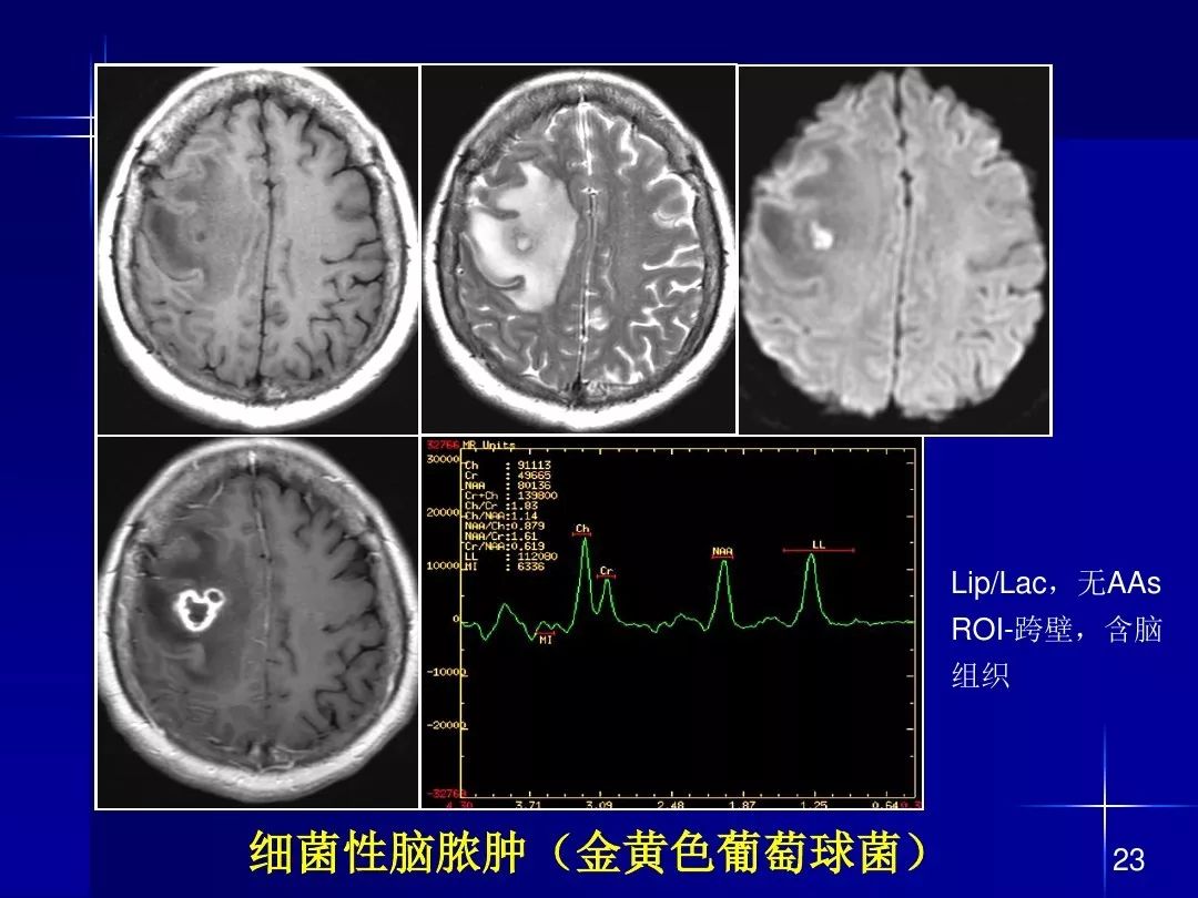 【PPT】脑内常见环形强化病变影像诊断与鉴别诊断