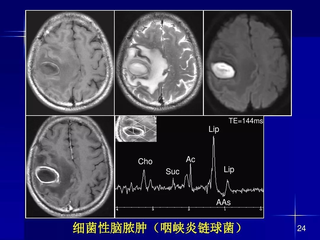 【PPT】脑内常见环形强化病变影像诊断与鉴别诊断