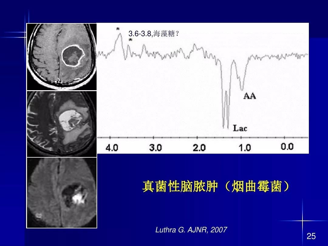 【PPT】脑内常见环形强化病变影像诊断与鉴别诊断