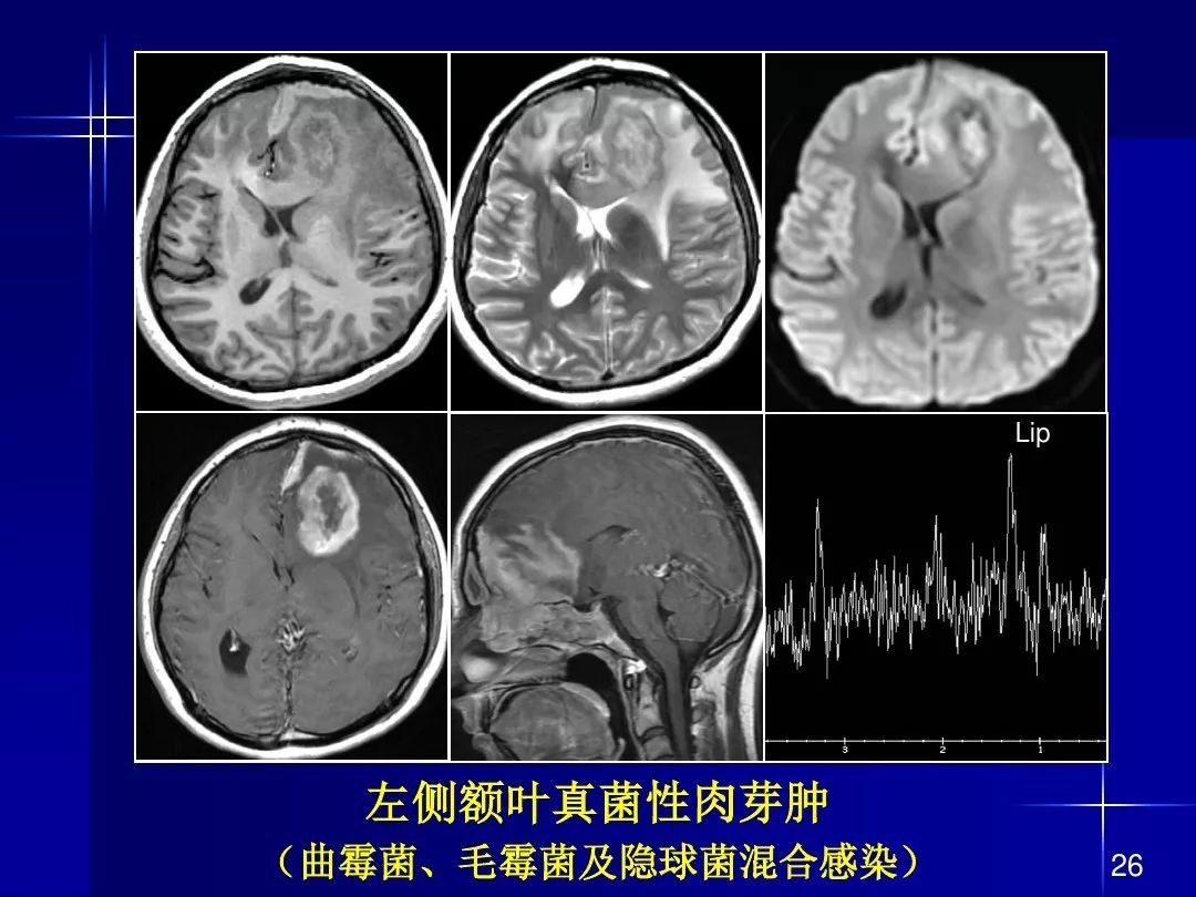 【PPT】脑内常见环形强化病变影像诊断与鉴别诊断