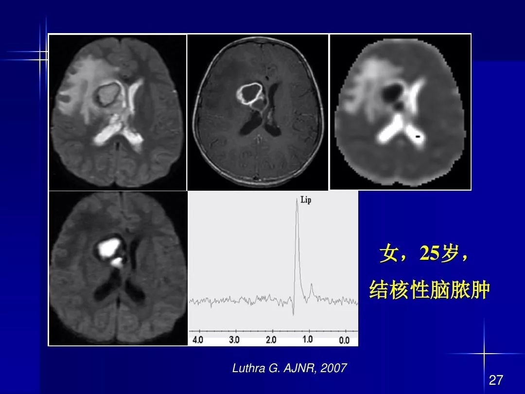 【PPT】脑内常见环形强化病变影像诊断与鉴别诊断