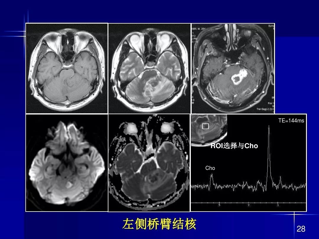 【PPT】脑内常见环形强化病变影像诊断与鉴别诊断