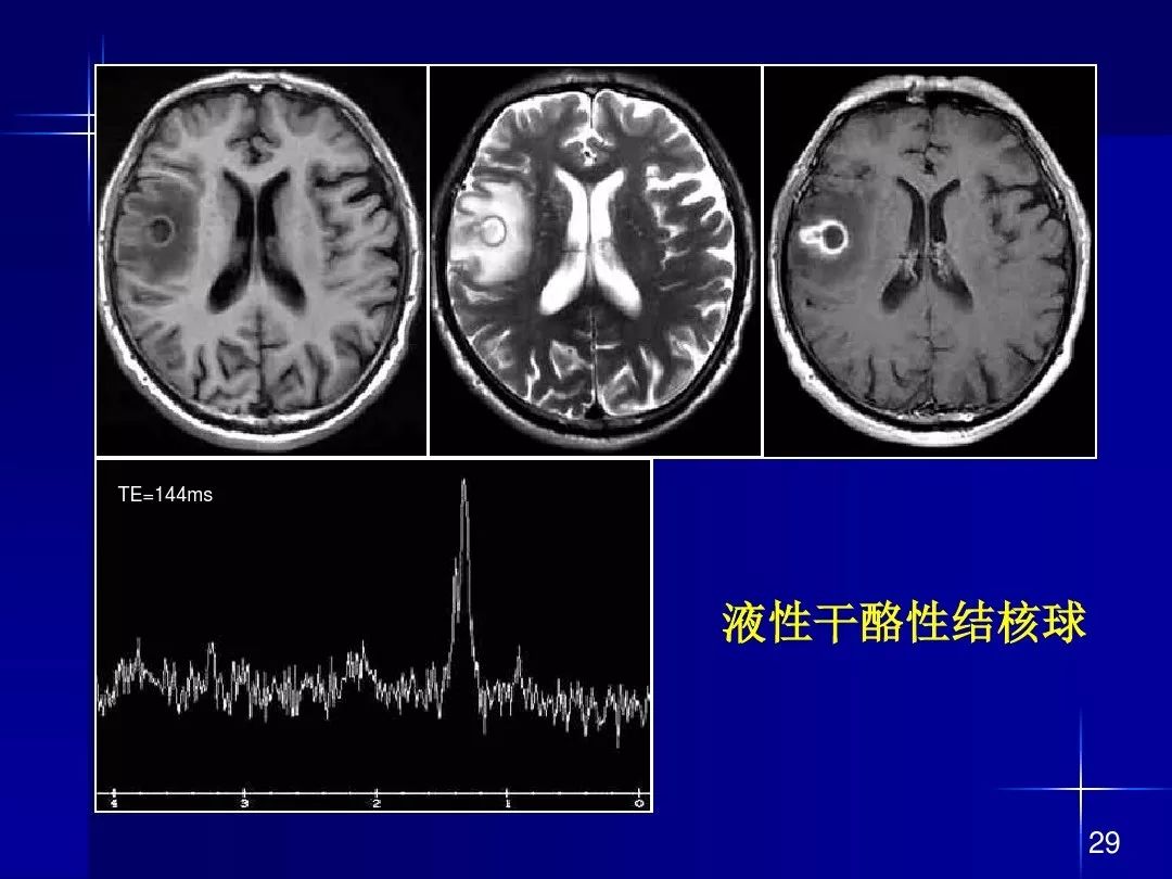 【PPT】脑内常见环形强化病变影像诊断与鉴别诊断