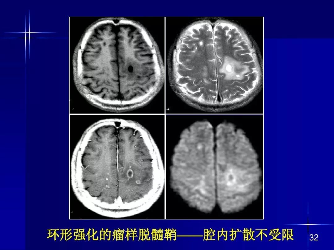 【PPT】脑内常见环形强化病变影像诊断与鉴别诊断