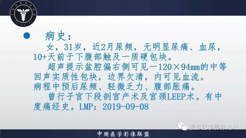 【病例】卵巢黄素化卵泡膜细胞瘤1例CT影像