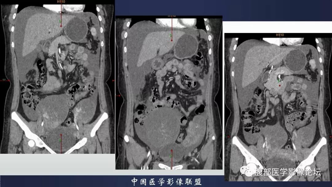 【病例】卵巢黄素化卵泡膜细胞瘤1例CT影像